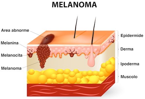 melanoma cutaneo 1